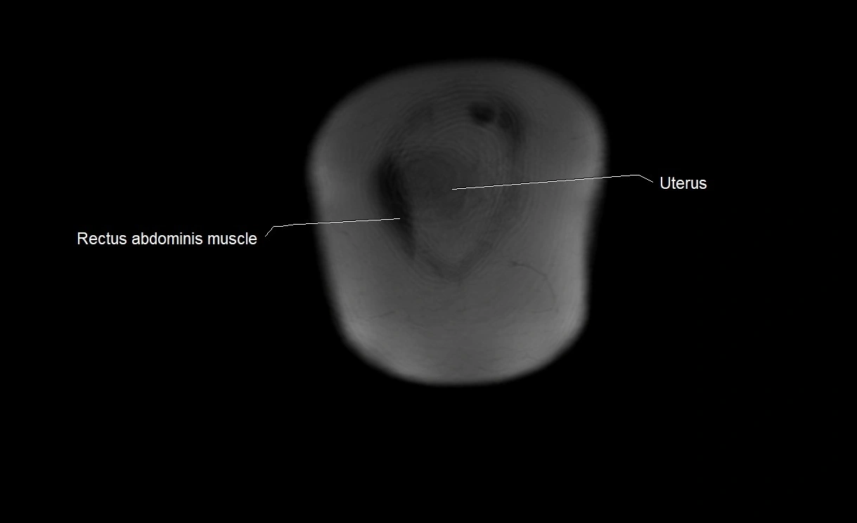 MRI Anatomy of pregnancy image 1.webp